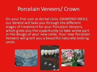 Porcelain Veneers/ Crown
On your first visit at dental clinic DIAMOND SMILE,
our dentist will take you through the different
stages of treatment for your Porcelain Veneers,
which gives you the opportunity to take active part
in the design of your new smile. Your new Porcelain
Veneers will grant you a beautiful naturally looking
smile.
 