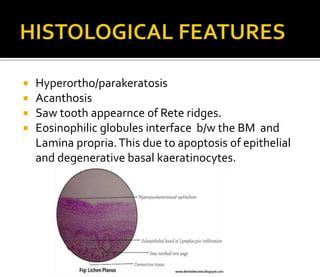 ORAL LICHEN PLANUS | PPT