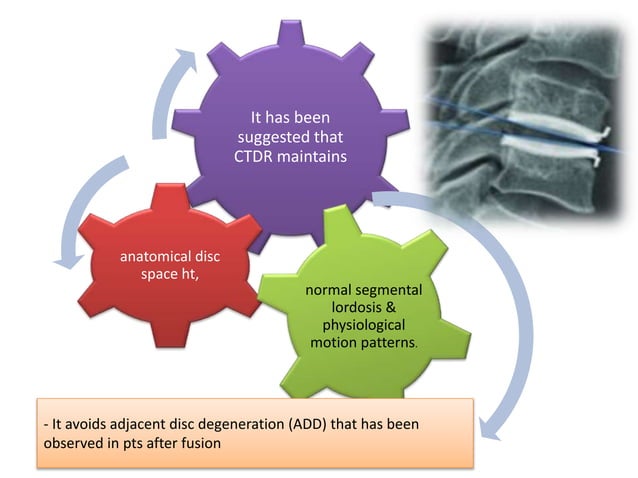 Artificial disc replacement vs ACDF | PPTX