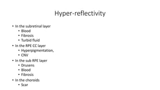 Hyper-reflectivity
• In the subretinal layer
• Blood
• Fibrosis
• Turbid fluid
• In the RPE CC layer
• Hyperpigmentation,
• CNV
• In the sub RPE layer
• Drusens
• Blood
• Fibrosis
• In the choroids
• Scar
 