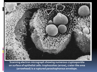 Scanning electron micrograph showing numerous cryptosporidia
on surface of epithelial cells: trophozoites (arrow), crater-like area
(arrowhead) is a ruptured parasitophorous envelope.
 