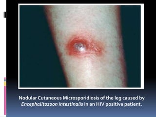 Nodular Cutaneous Microsporidiosis of the leg caused by
Encephalitozoon intestinalis in an HIV positive patient.
 