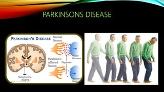 PARKINSONS DISEASE
 