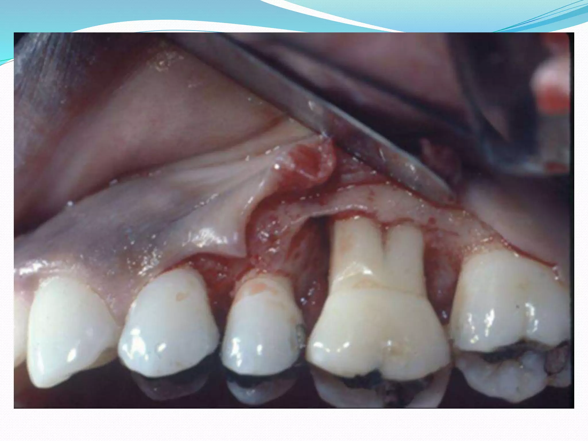 diagnosis of pulpal pathologies | PPTX