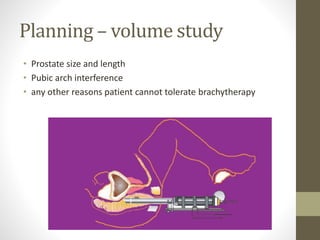 Planning – volume study
• Prostate size and length
• Pubic arch interference
• any other reasons patient cannot tolerate brachytherapy
 