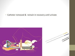 • Catheter removed & remain in recovery until urinate
 
