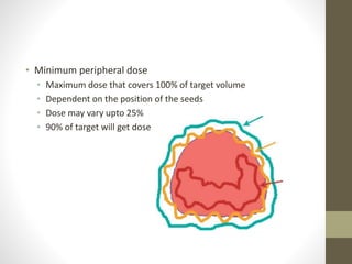 • Minimum peripheral dose
• Maximum dose that covers 100% of target volume
• Dependent on the position of the seeds
• Dose may vary upto 25%
• 90% of target will get dose
 