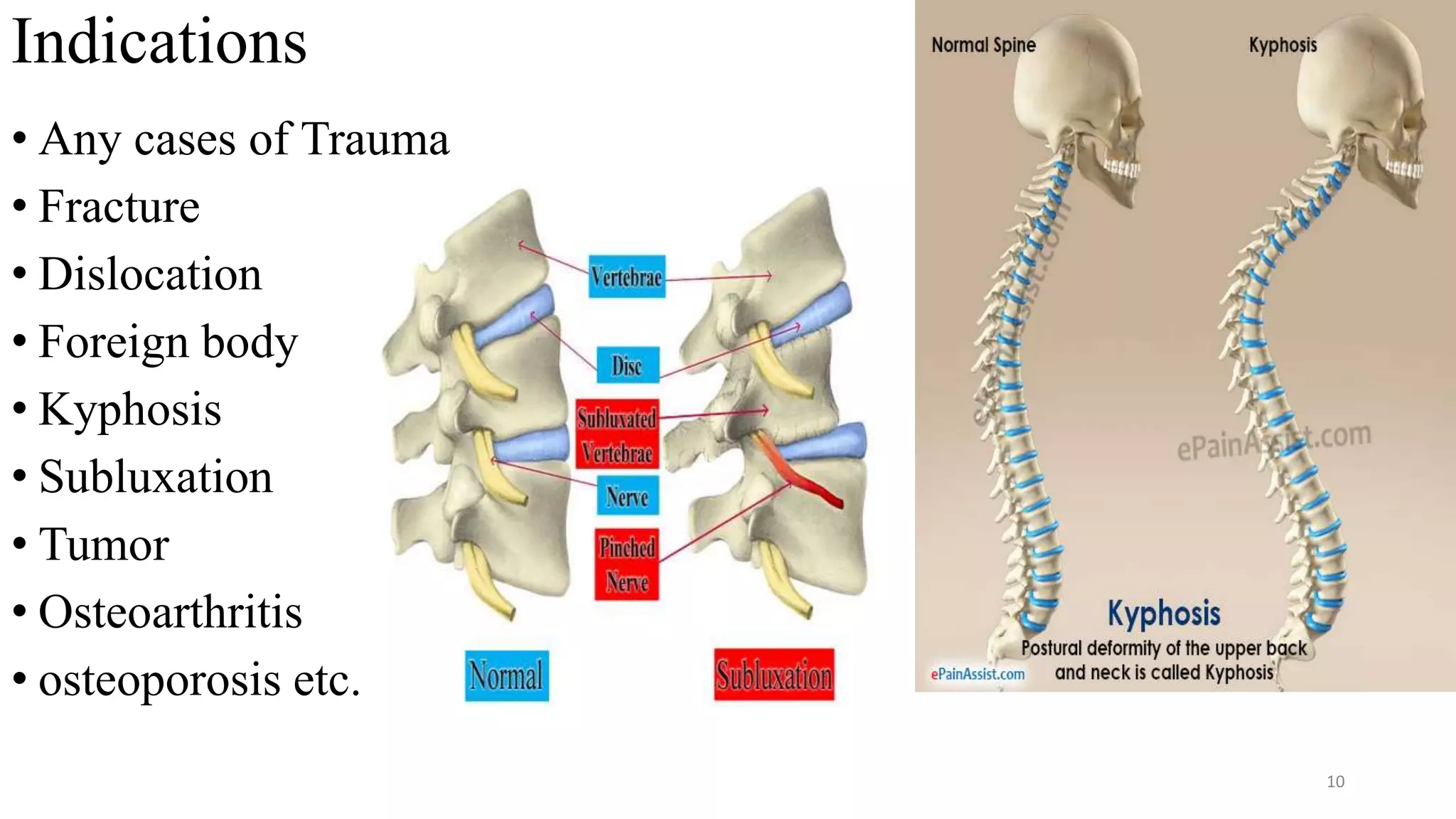 Indications
• Any cases of Trauma
• Fracture
• Dislocation
• Foreign body
• Kyphosis
• Subluxation
• Tumor
• Osteoarthritis
• osteoporosis etc.
10
 