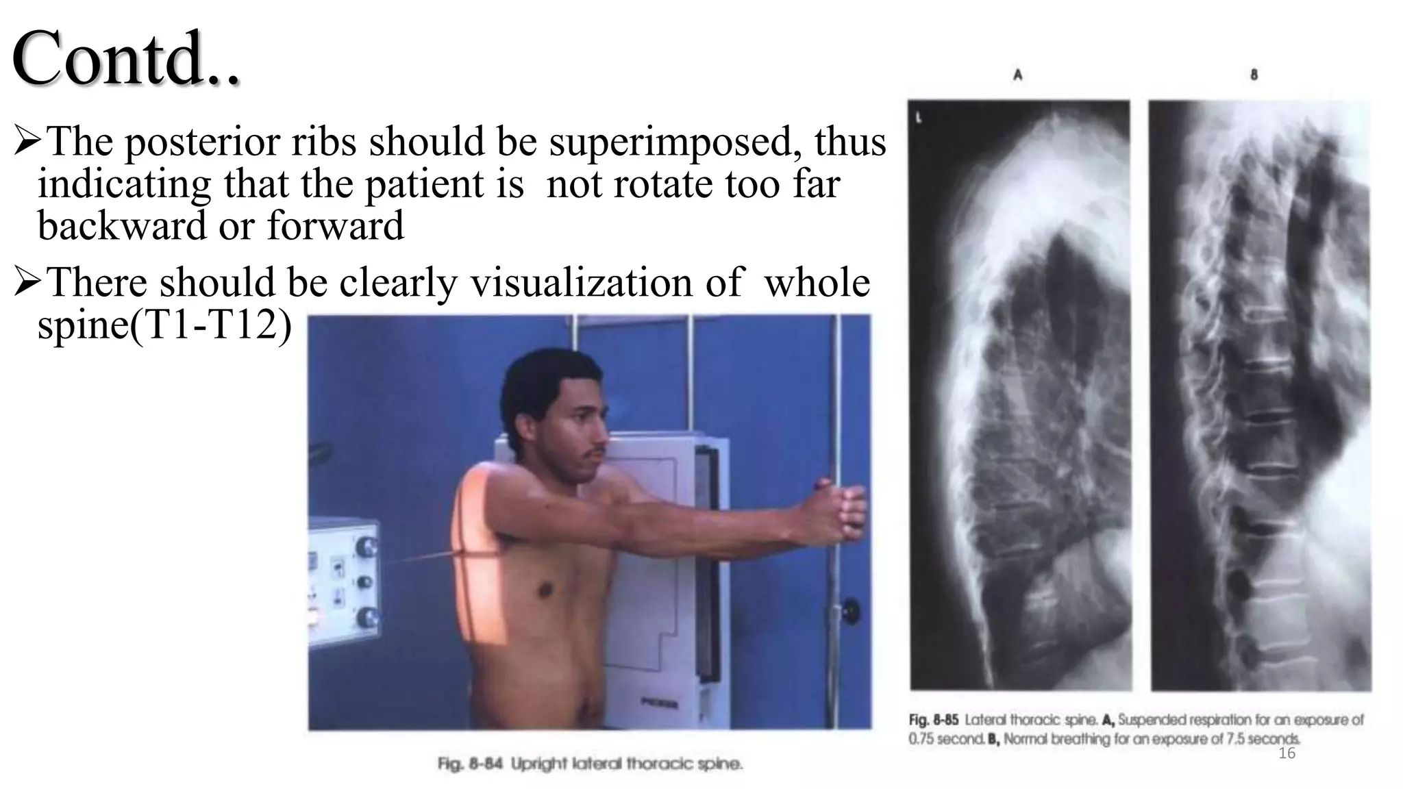 Contd..
The posterior ribs should be superimposed, thus
indicating that the patient is not rotate too far
backward or forward
There should be clearly visualization of whole
spine(T1-T12)
16
 