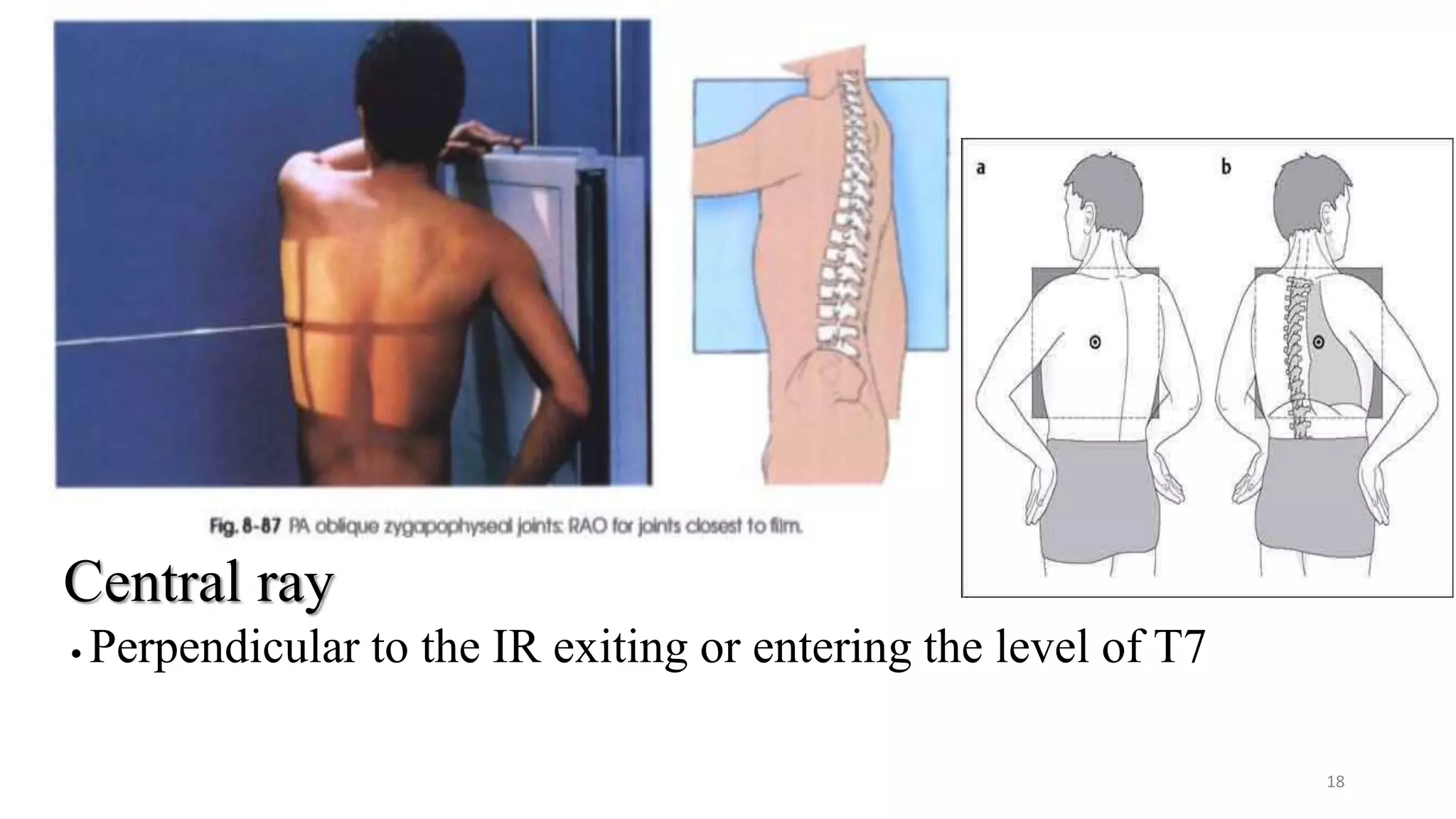 Central ray
• Perpendicular to the IR exiting or entering the level of T7
18
 