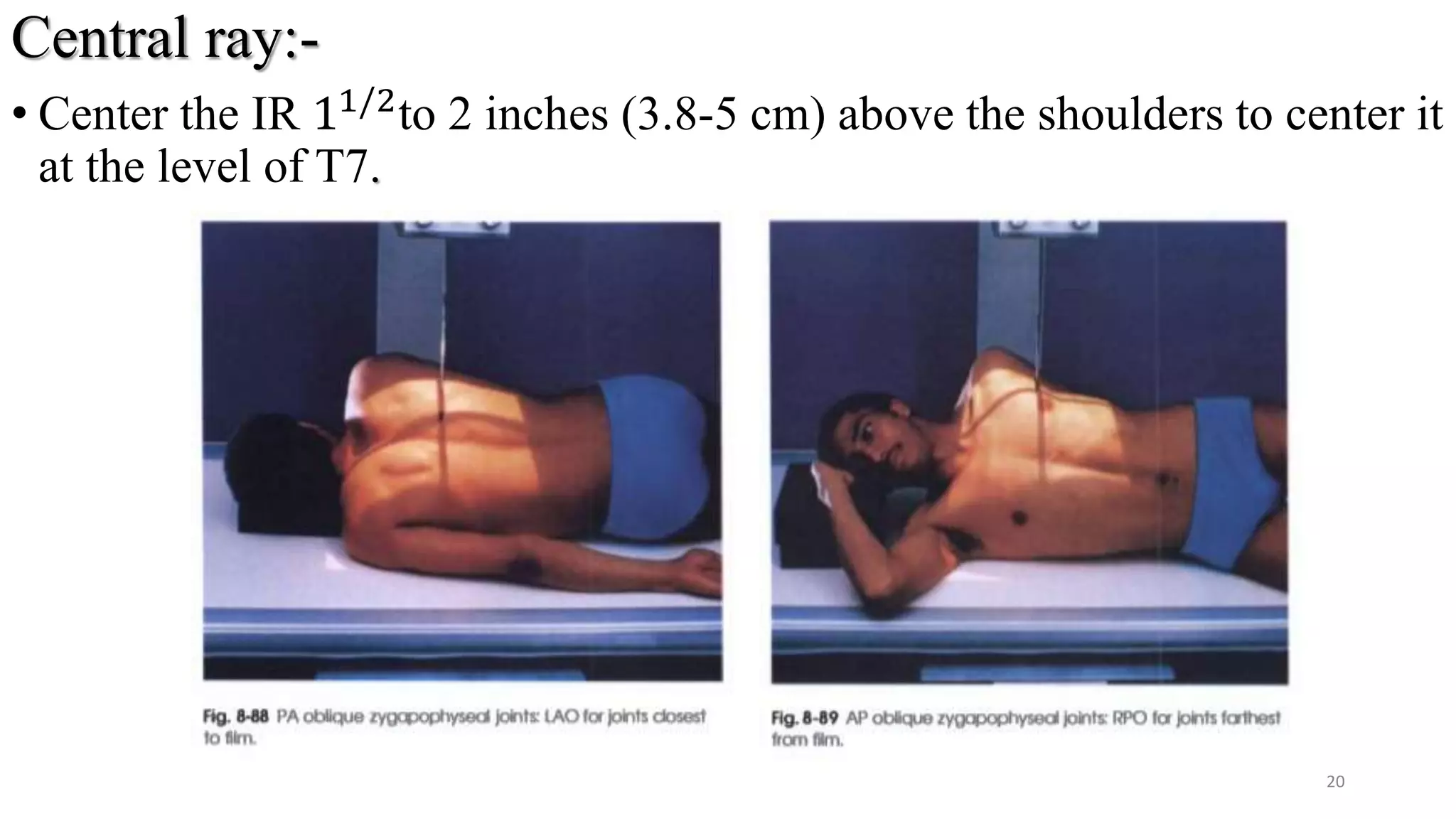 Central ray:-
• Center the IR 11/2
to 2 inches (3.8-5 cm) above the shoulders to center it
at the level of T7.
20
 