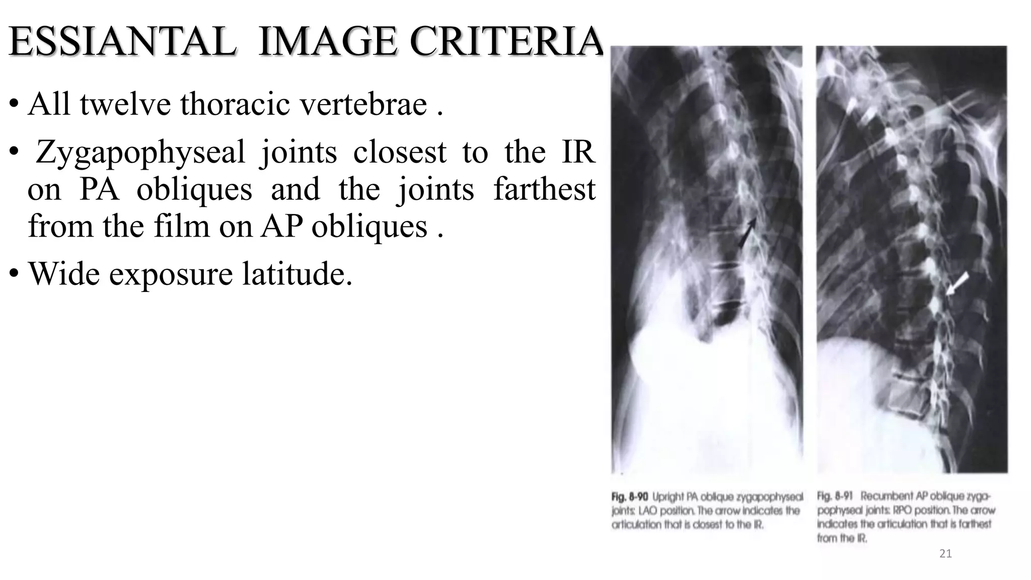 ESSIANTAL IMAGE CRITERIA
• All twelve thoracic vertebrae .
• Zygapophyseal joints closest to the IR
on PA obliques and the joints farthest
from the film on AP obliques .
• Wide exposure latitude.
21
 