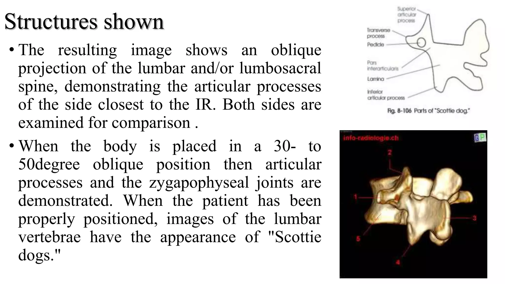 Structures shown
• The resulting image shows an oblique
projection of the lumbar and/or lumbosacral
spine, demonstrating the articular processes
of the side closest to the IR. Both sides are
examined for comparison .
• When the body is placed in a 30- to
50degree oblique position then articular
processes and the zygapophyseal joints are
demonstrated. When the patient has been
properly positioned, images of the lumbar
vertebrae have the appearance of "Scottie
dogs."
36
 