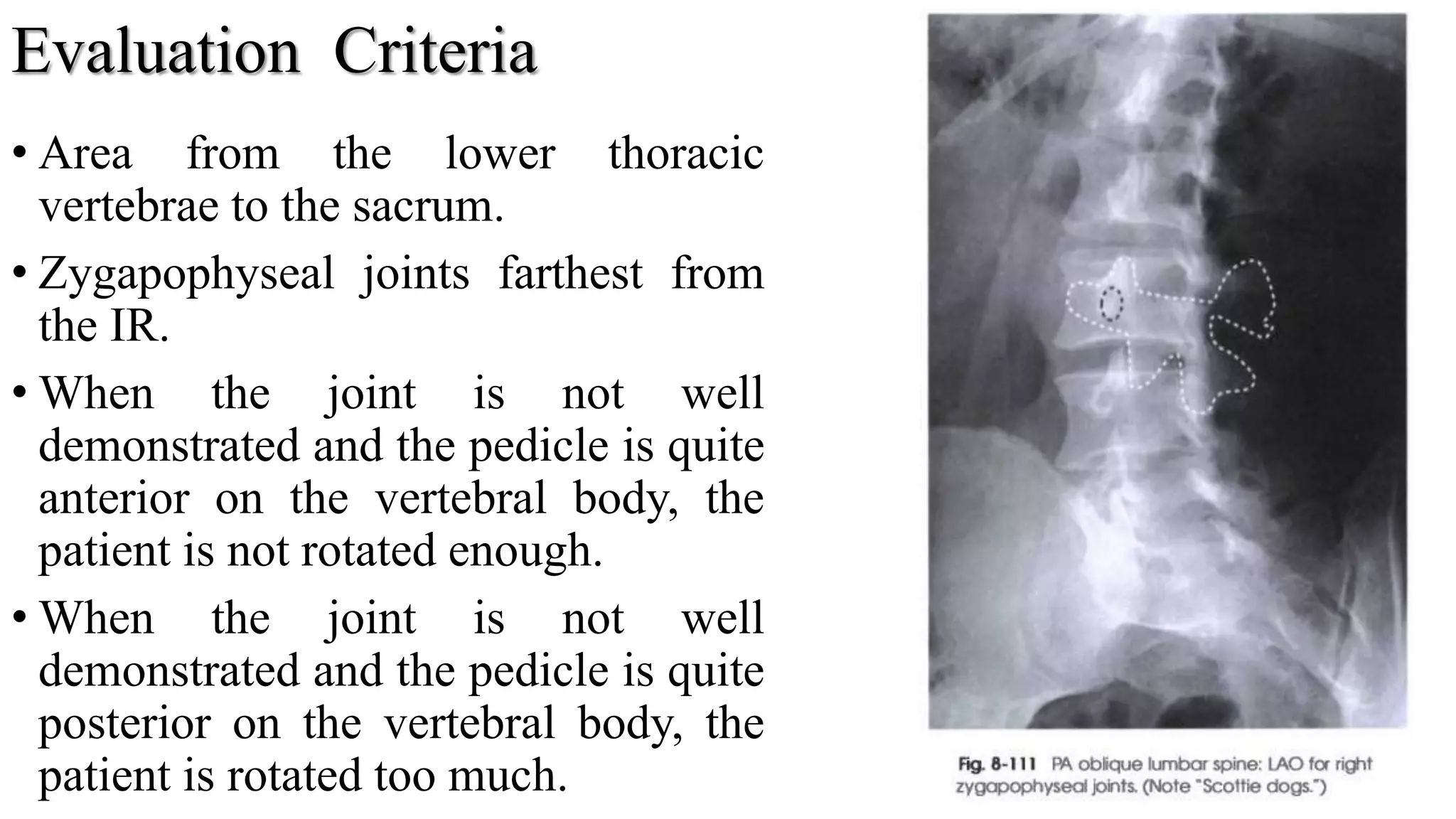 Evaluation Criteria
• Area from the lower thoracic
vertebrae to the sacrum.
• Zygapophyseal joints farthest from
the IR.
• When the joint is not well
demonstrated and the pedicle is quite
anterior on the vertebral body, the
patient is not rotated enough.
• When the joint is not well
demonstrated and the pedicle is quite
posterior on the vertebral body, the
patient is rotated too much. 42
 
