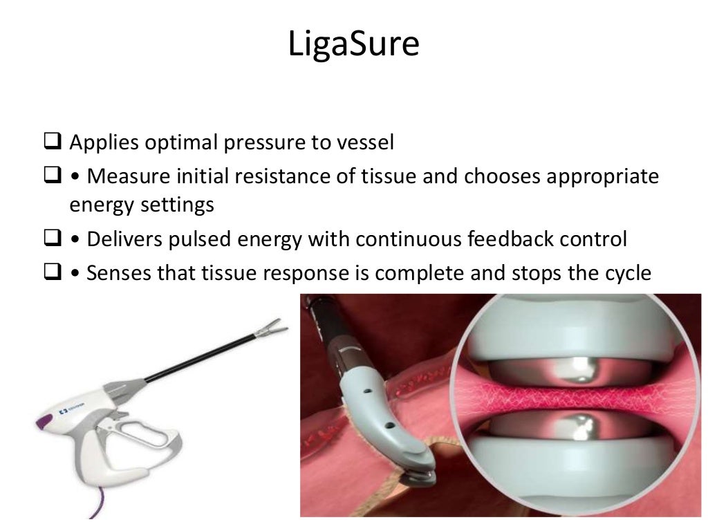 ENERGY DEVICES IN SURGERY