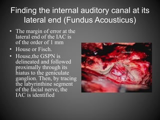 Finding the internal auditory canal at its
lateral end (Fundus Acousticus)
• The margin of error at the
lateral end of the IAC is
of the order of 1 mm
• House or Fisch.
• House,the GSPN is
delineated and followed
proximally through its
hiatus to the geniculate
ganglion. Then, by tracing
the labyrinthine segment
of the facial nerve, the
IAC is identified
 