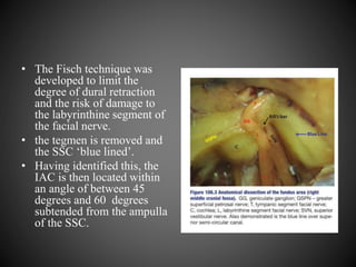 • The Fisch technique was
developed to limit the
degree of dural retraction
and the risk of damage to
the labyrinthine segment of
the facial nerve.
• the tegmen is removed and
the SSC ‘blue lined’.
• Having identified this, the
IAC is then located within
an angle of between 45
degrees and 60 degrees
subtended from the ampulla
of the SSC.
 