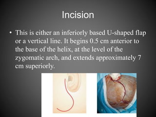 Incision
• This is either an inferiorly based U-shaped flap
or a vertical line. It begins 0.5 cm anterior to
the base of the helix, at the level of the
zygomatic arch, and extends approximately 7
cm superiorly.
 