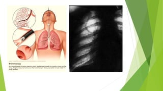 Pneumosclerosis pneumosclerosis | PPTX