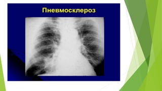 Pneumosclerosis pneumosclerosis | PPTX