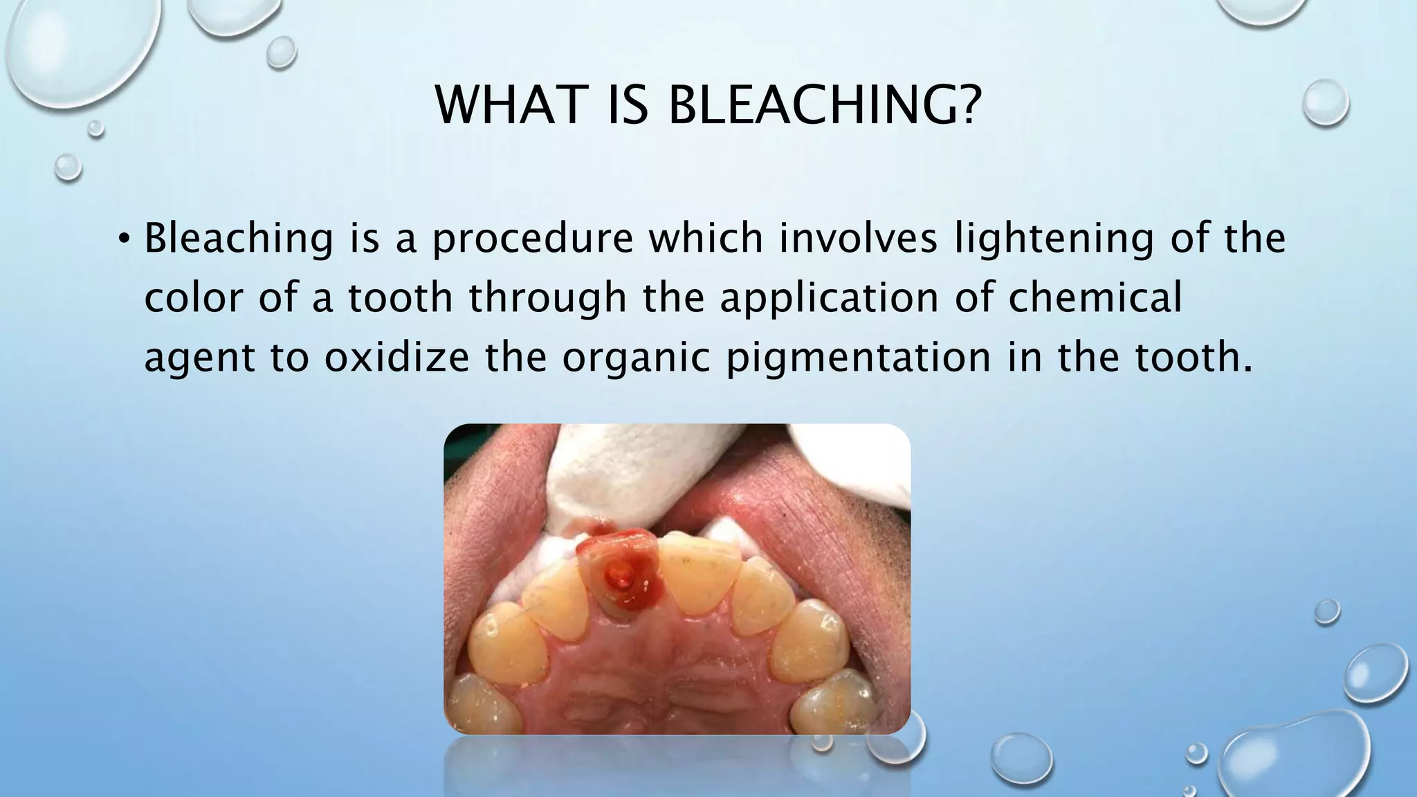 Management of discolored tooth | PPTX