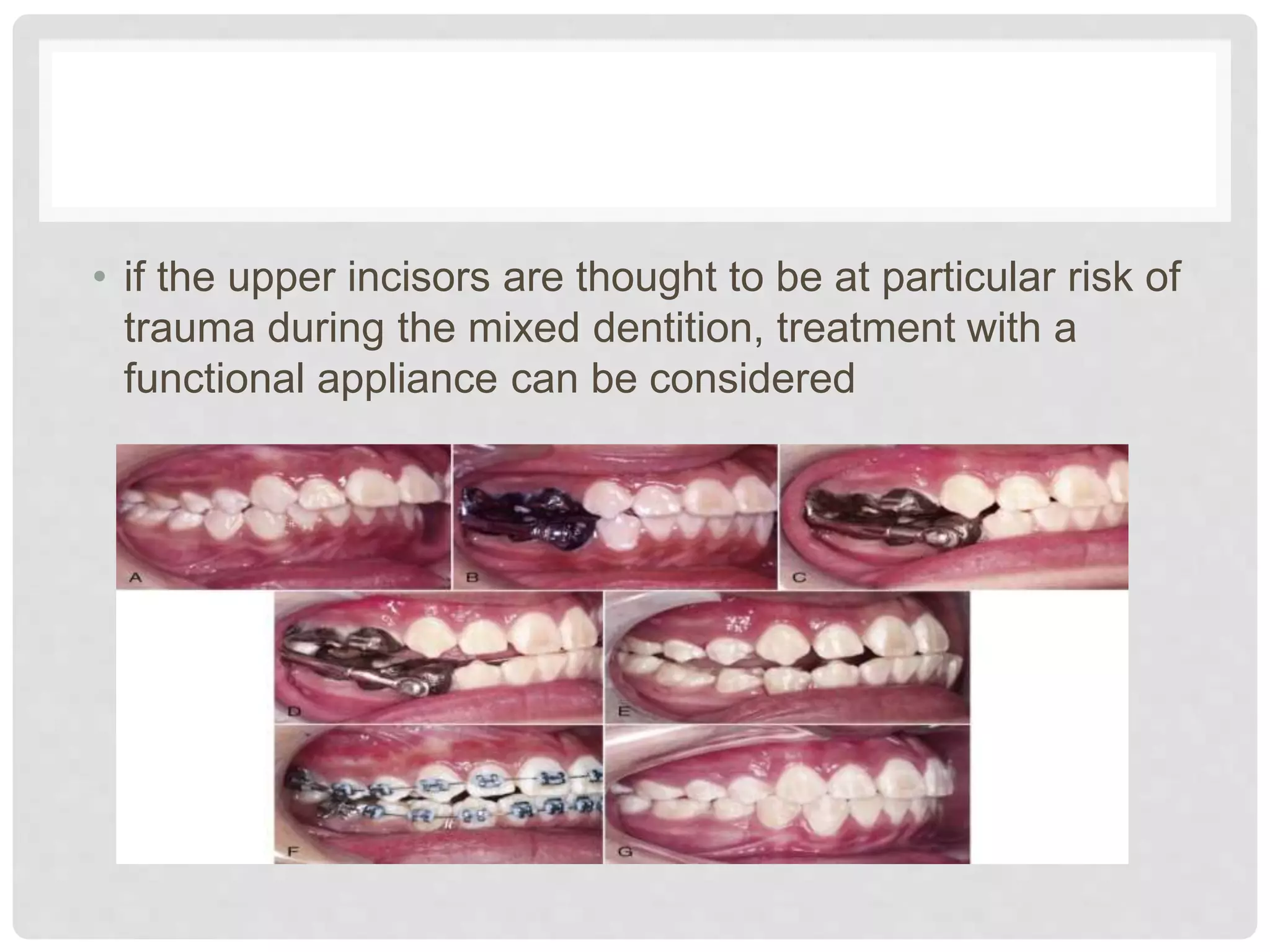 • if the upper incisors are thought to be at particular risk of
trauma during the mixed dentition, treatment with a
functional appliance can be considered
 