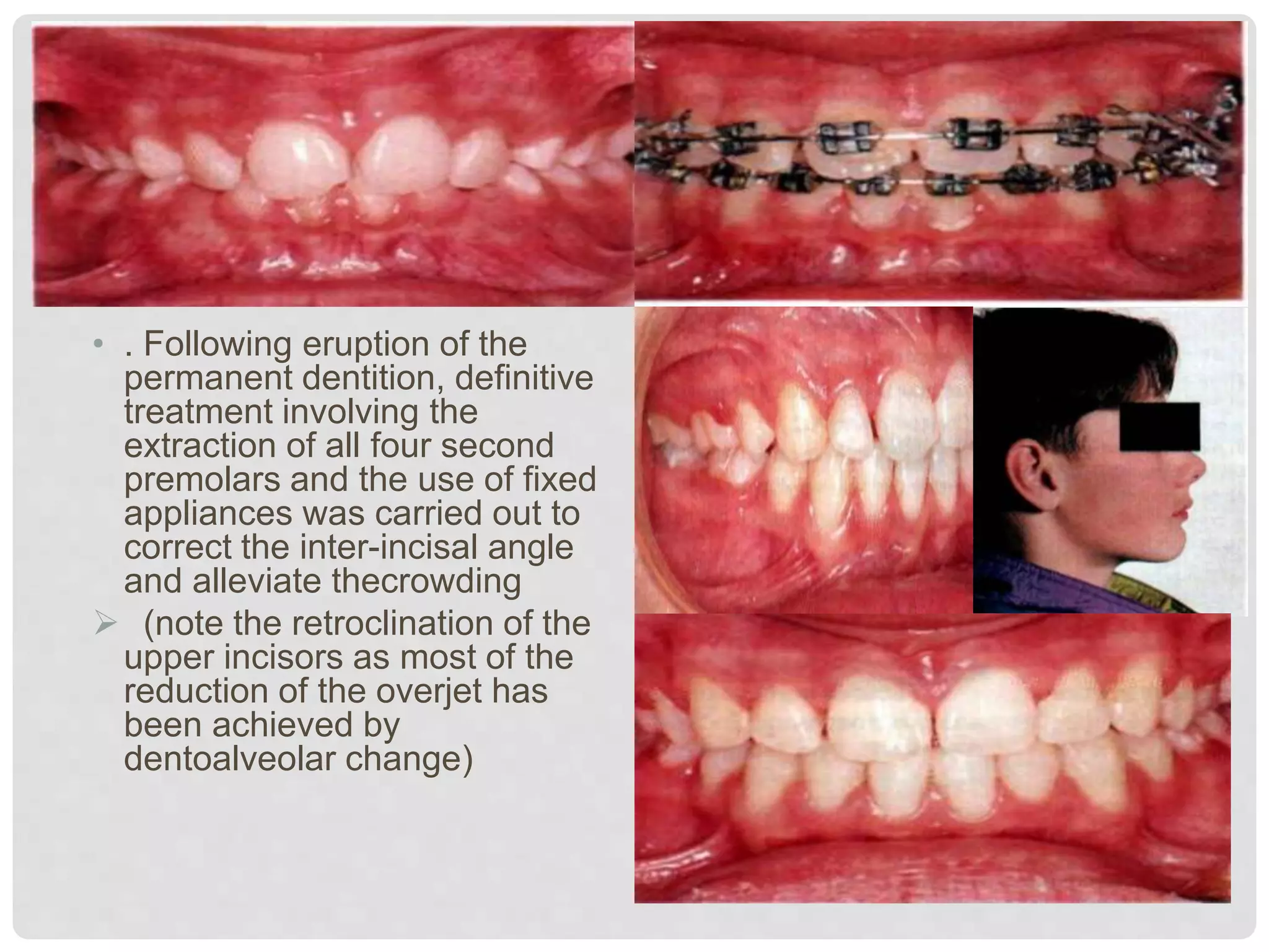 • . Following eruption of the
permanent dentition, definitive
treatment involving the
extraction of all four second
premolars and the use of fixed
appliances was carried out to
correct the inter-incisal angle
and alleviate thecrowding
 (note the retroclination of the
upper incisors as most of the
reduction of the overjet has
been achieved by
dentoalveolar change)
 