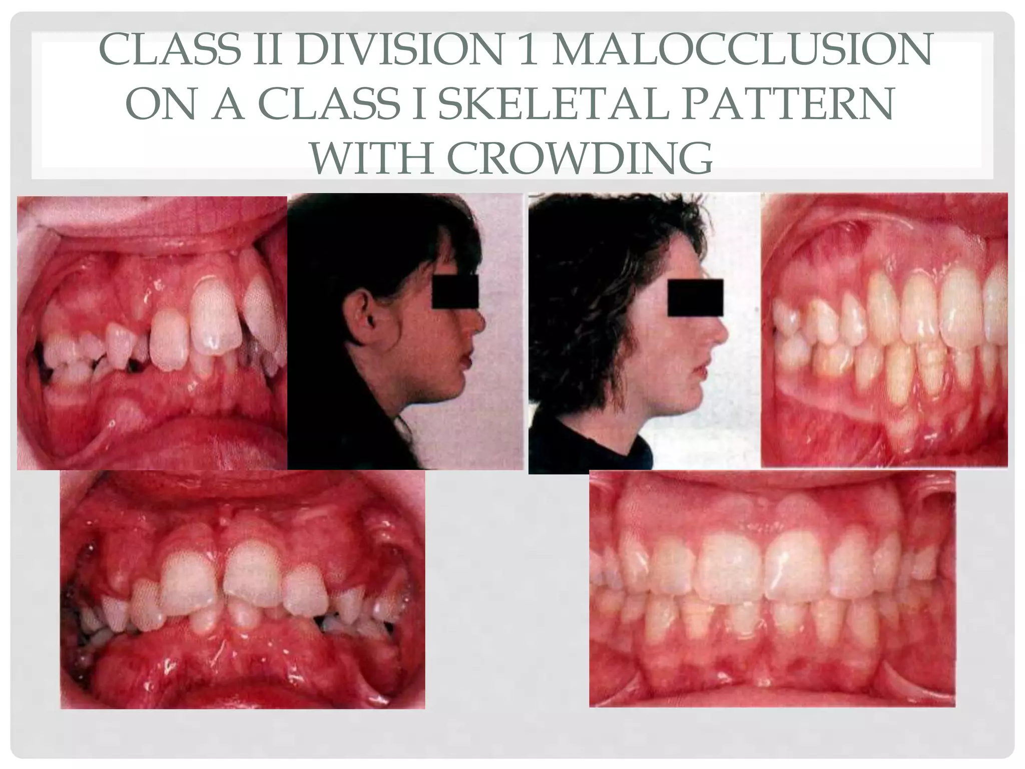 CLASS II DIVISION 1 MALOCCLUSION
ON A CLASS I SKELETAL PATTERN
WITH CROWDING
 