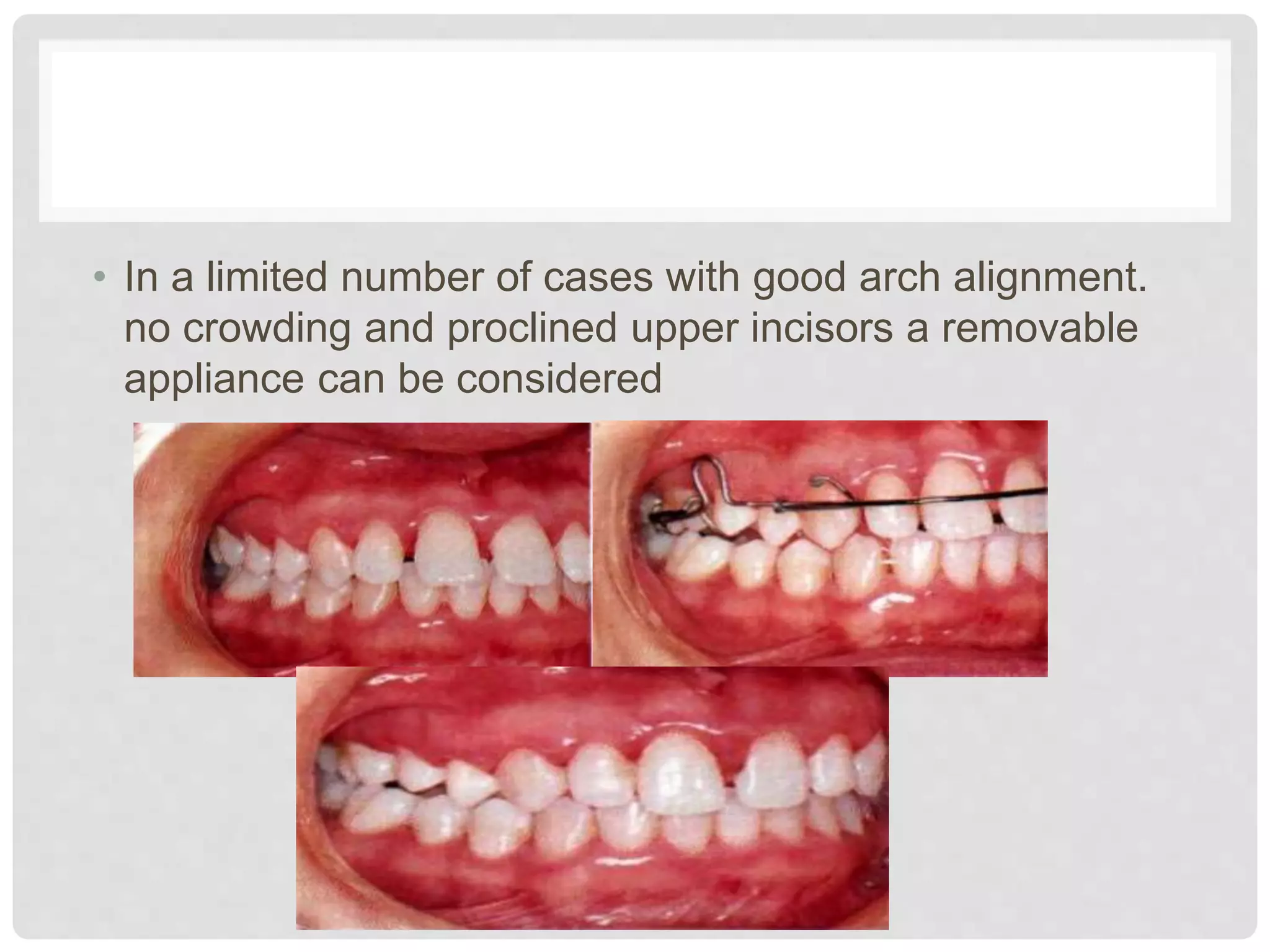 • In a limited number of cases with good arch alignment.
no crowding and proclined upper incisors a removable
appliance can be considered
 