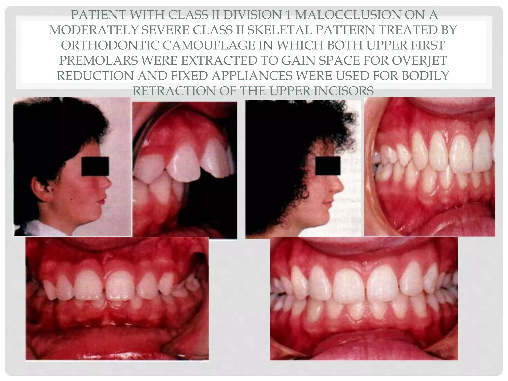 PATIENT WITH CLASS II DIVISION 1 MALOCCLUSION ON A
MODERATELY SEVERE CLASS II SKELETAL PATTERN TREATED BY
ORTHODONTIC CAMOUFLAGE IN WHICH BOTH UPPER FIRST
PREMOLARS WERE EXTRACTED TO GAIN SPACE FOR OVERJET
REDUCTION AND FIXED APPLIANCES WERE USED FOR BODILY
RETRACTION OF THE UPPER INCISORS
 
