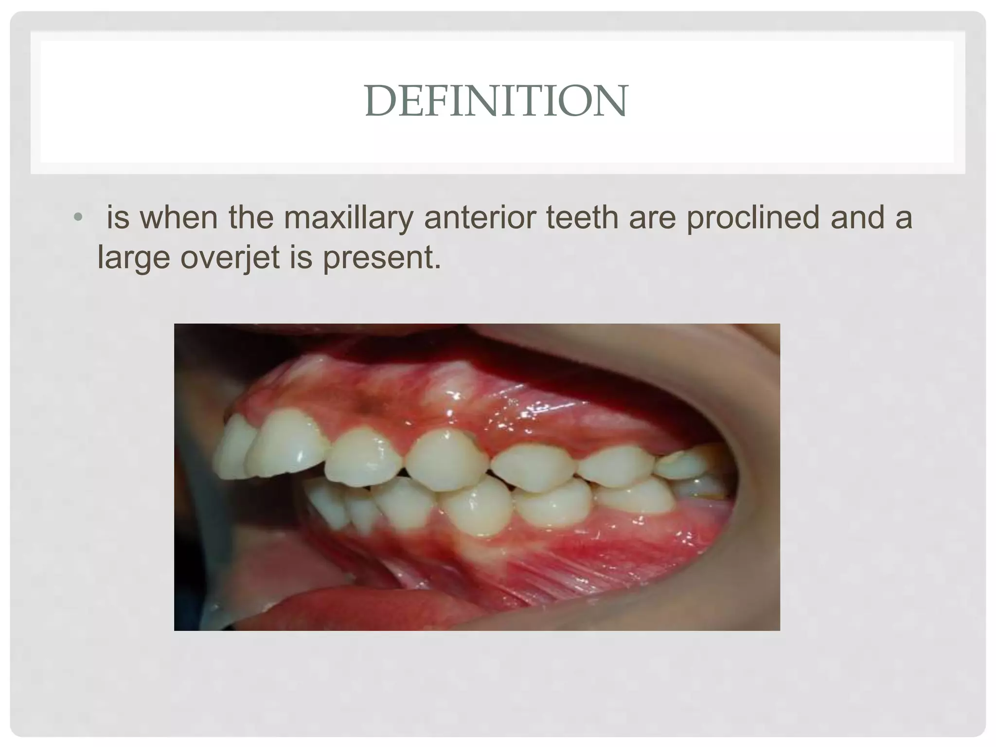 DEFINITION
• is when the maxillary anterior teeth are proclined and a
large overjet is present.
 