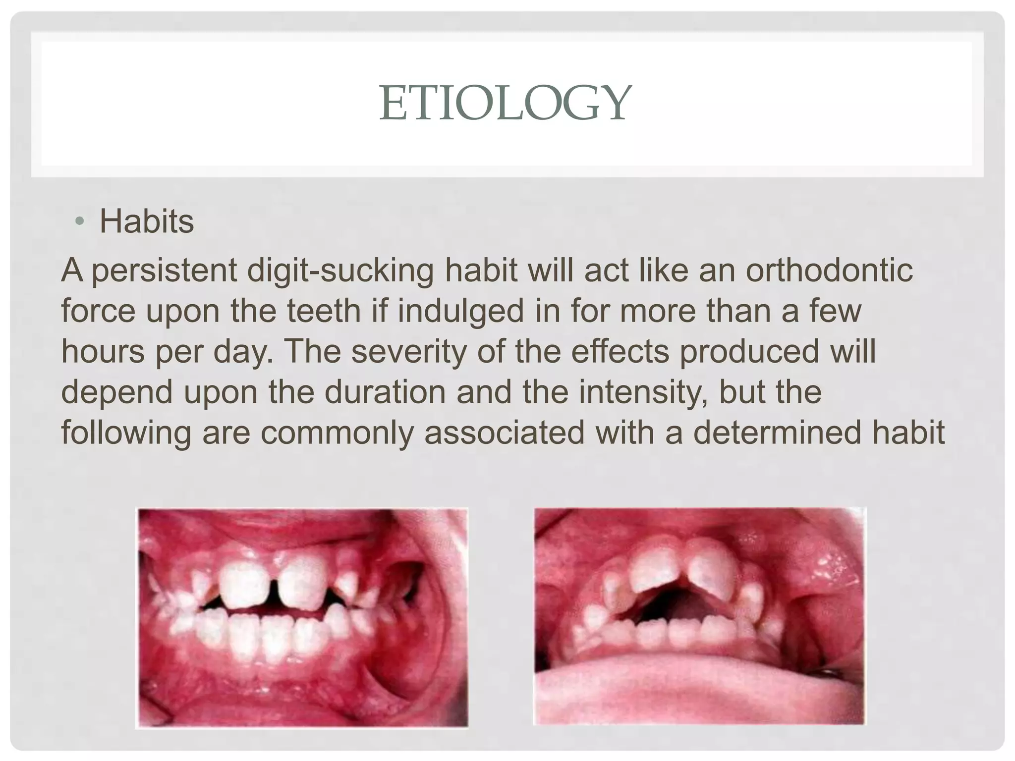 ETIOLOGY
• Habits
A persistent digit-sucking habit will act like an orthodontic
force upon the teeth if indulged in for more than a few
hours per day. The severity of the effects produced will
depend upon the duration and the intensity, but the
following are commonly associated with a determined habit
 