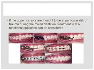 • if the upper incisors are thought to be at particular risk of
trauma during the mixed dentition, treatment with a
functional appliance can be considered
 