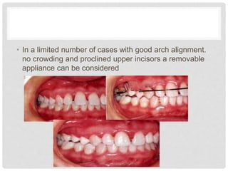 • In a limited number of cases with good arch alignment.
no crowding and proclined upper incisors a removable
appliance can be considered
 