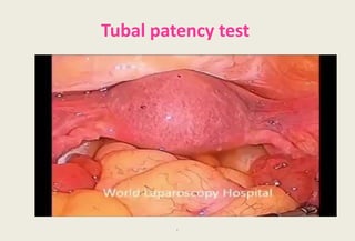 Tube Patency Endoscopy and laparoscopy in gynecology and obstetric | PPTX