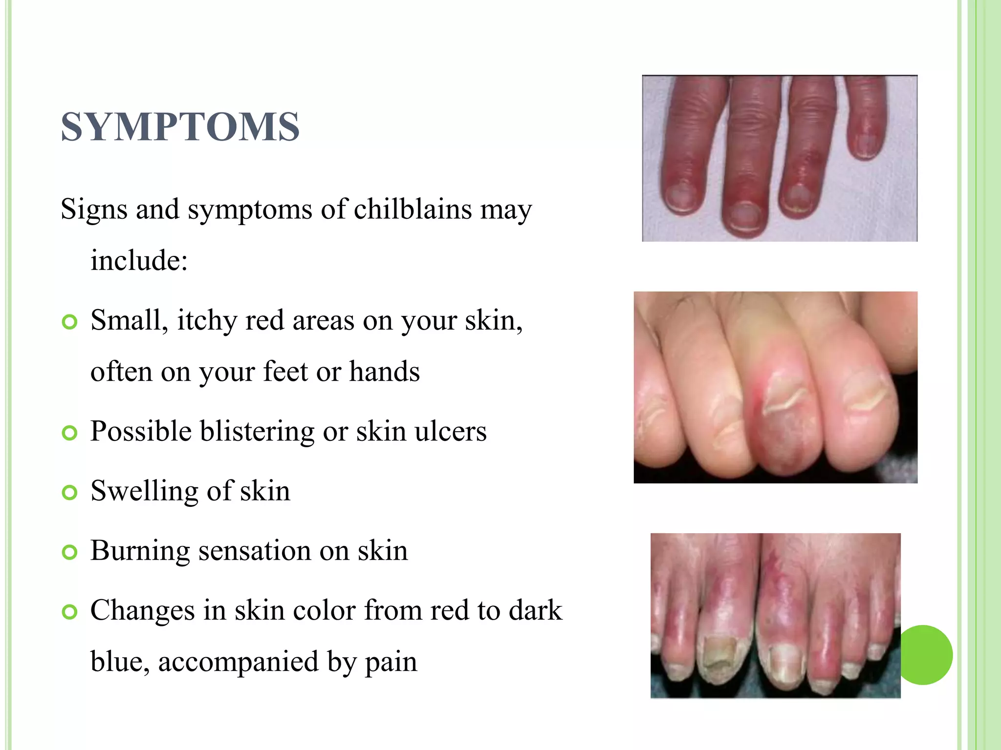 CHILBLAINS | PPTX | Skin and Dermatology | Diseases and Conditions