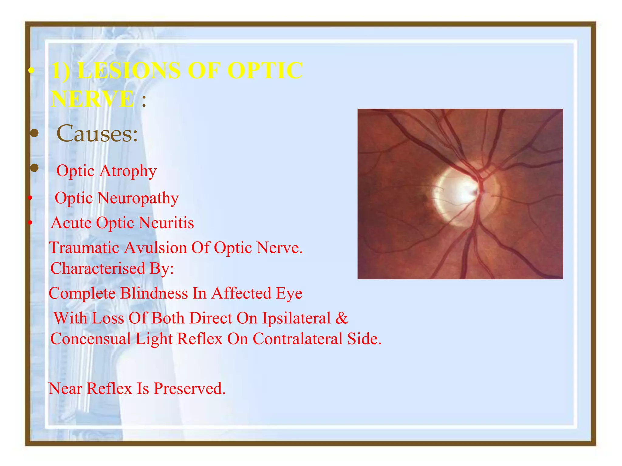 • 1) LESIONS OF OPTIC
NERVE :
• Causes:
• Optic Atrophy
• Optic Neuropathy
• Acute Optic Neuritis
Traumatic Avulsion Of Optic Nerve.
Characterised By:
Complete Blindness In Affected Eye
With Loss Of Both Direct On Ipsilateral &
Concensual Light Reflex On Contralateral Side.
Near Reflex Is Preserved.
 