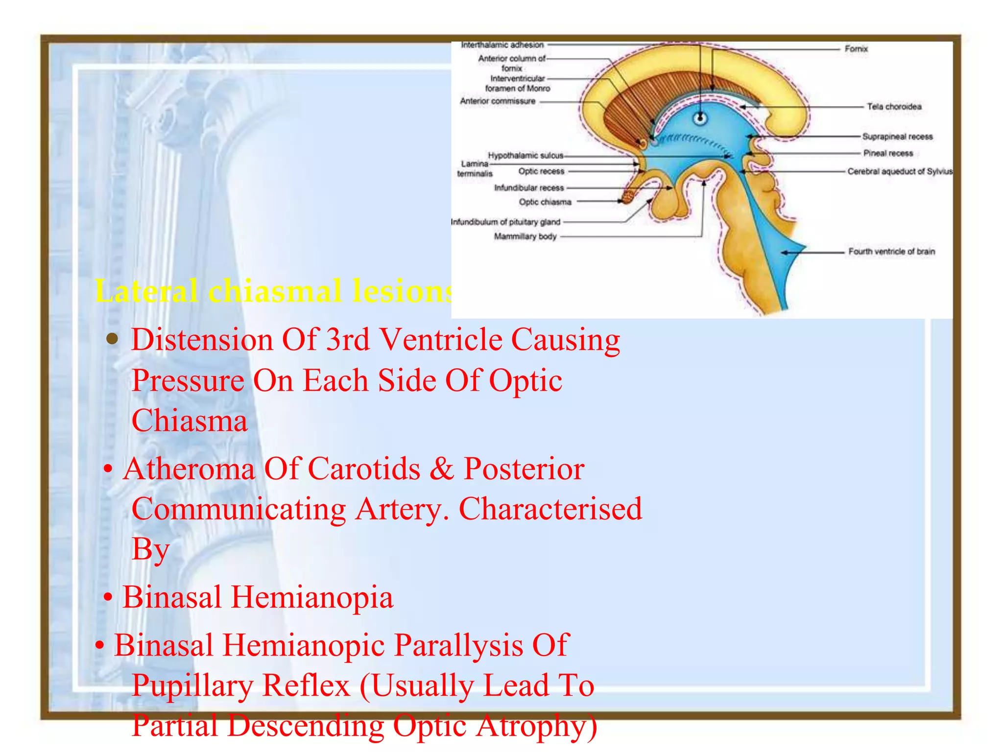 Lateral chiasmal lesions : causes:
• Distension Of 3rd Ventricle Causing
Pressure On Each Side Of Optic
Chiasma
• Atheroma Of Carotids & Posterior
Communicating Artery. Characterised
By
• Binasal Hemianopia
• Binasal Hemianopic Parallysis Of
Pupillary Reflex (Usually Lead To
Partial Descending Optic Atrophy)
 