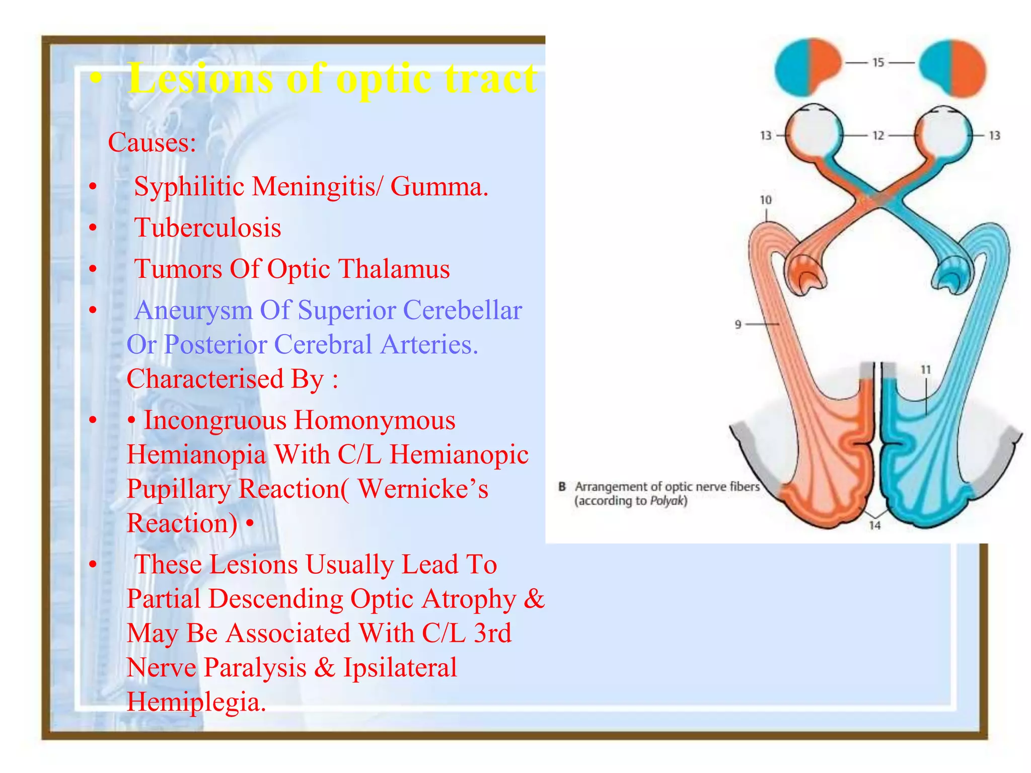 • Lesions of optic tract
Causes:
• Syphilitic Meningitis/ Gumma.
• Tuberculosis
• Tumors Of Optic Thalamus
• Aneurysm Of Superior Cerebellar
Or Posterior Cerebral Arteries.
Characterised By :
• • Incongruous Homonymous
Hemianopia With C/L Hemianopic
Pupillary Reaction( Wernicke’s
Reaction) •
• These Lesions Usually Lead To
Partial Descending Optic Atrophy &
May Be Associated With C/L 3rd
Nerve Paralysis & Ipsilateral
Hemiplegia.
 