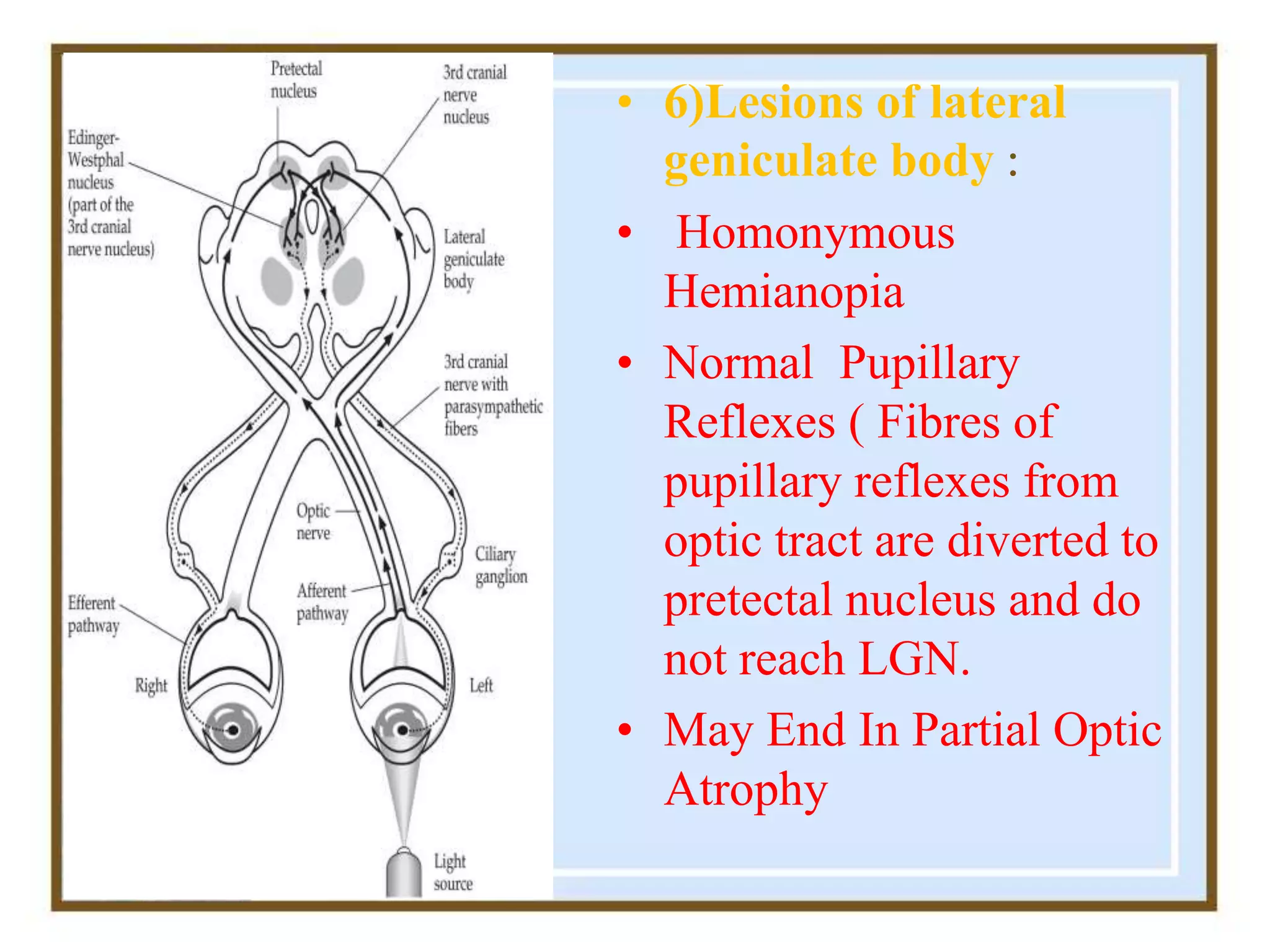 • 6)Lesions of lateral
geniculate body :
• Homonymous
Hemianopia
• Normal Pupillary
Reflexes ( Fibres of
pupillary reflexes from
optic tract are diverted to
pretectal nucleus and do
not reach LGN.
• May End In Partial Optic
Atrophy
 