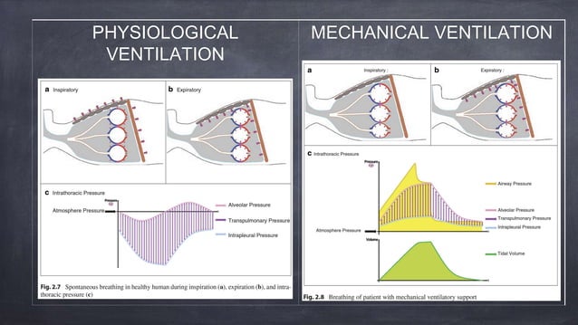 Mechanical Ventilation modes used clinically | PPTX | Lung and ...