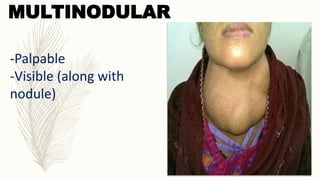 MULTINODULAR
-Palpable
-Visible (along with
nodule)
 
