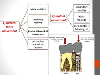 2)implant
movement
secondary
mobility
lateral
mobility
mesiodistal >
labiolingual
1) natural
tooth
movement
initial mobility
secondary
mobility
horizontal>vertical
movement
uncomplete
immediate
rebound
 