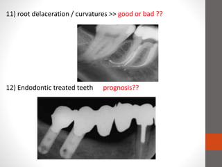 12) Endodontic treated teeth prognosis??
11) root delaceration / curvatures >> good or bad ??
 