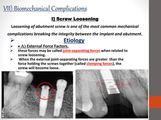 I] Screw Loosening
Loosening of abutment screw is one of the most common mechanical
complications breaking the integrity between the implant and abutment.
 Etiology
  A) External Force Factors.
 these forces may be called joint-separating forces when related to
screw loosening.
 When the external joint-separating forces are greater than the
force holding the screws together (called clamping forces), the
screw will become loose.
kkkkmkjnk
VII) Biomechanical Complications
 