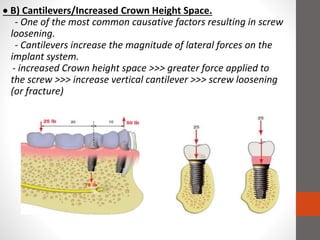  B) Cantilevers/Increased Crown Height Space.
- One of the most common causative factors resulting in screw
loosening.
- Cantilevers increase the magnitude of lateral forces on the
implant system.
- increased Crown height space >>> greater force applied to
the screw >>> increase vertical cantilever >>> screw loosening
(or fracture)
 