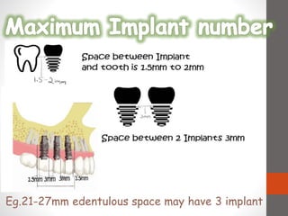 Eg.21-27mm edentulous space may have 3 implant
 