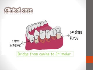 Bridge from canine to 2nd molar
 
