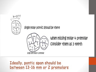 Ideally, pontic span should be
between 13-16 mm or 2 premolars
 
