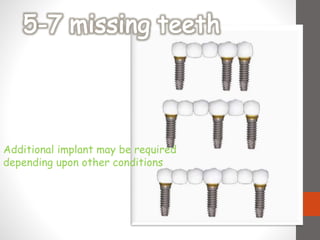 Additional implant may be required
depending upon other conditions
 